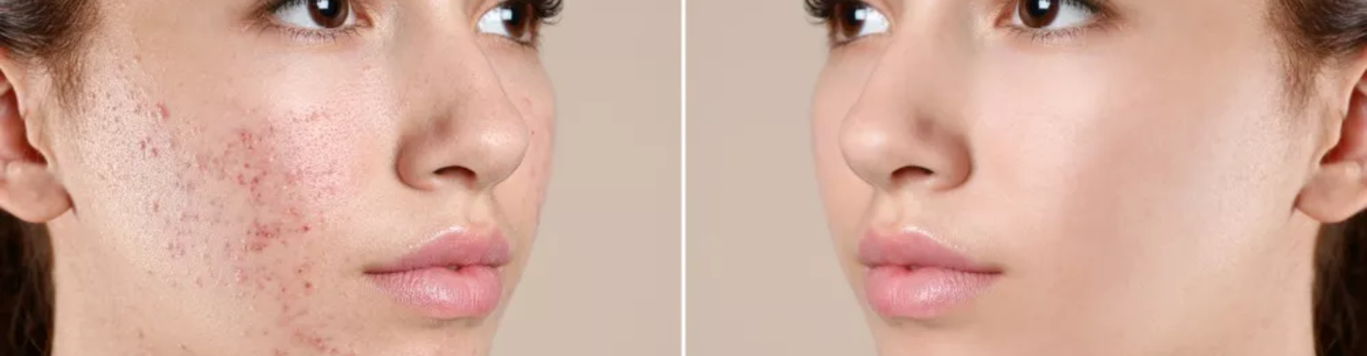 SCAR Treatment