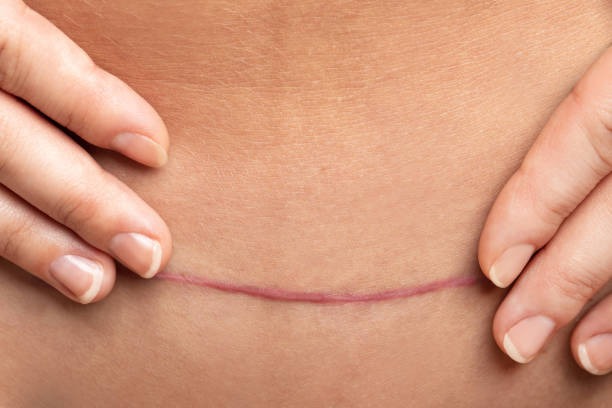 5 Common Misconceptions about Scar Removal in Pakistan