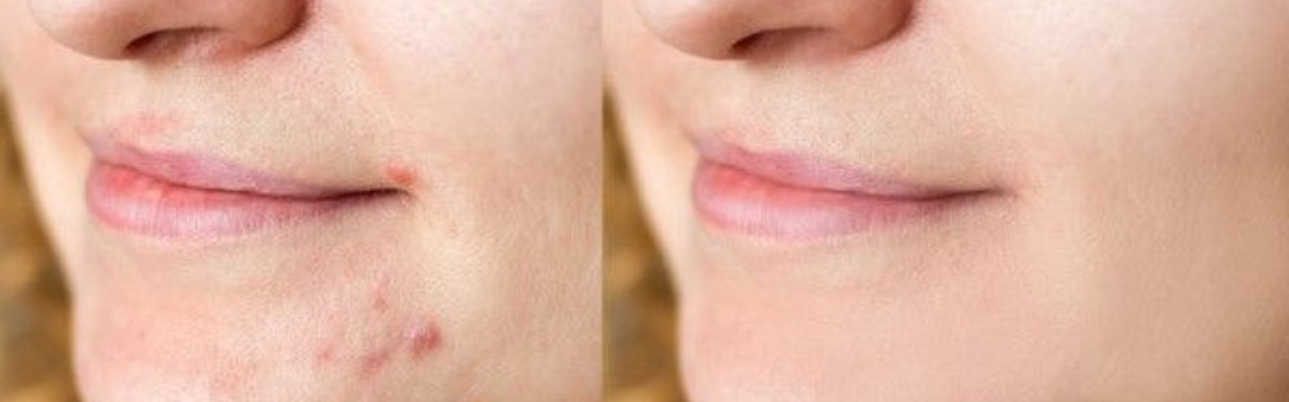Pigmentation Treatment
