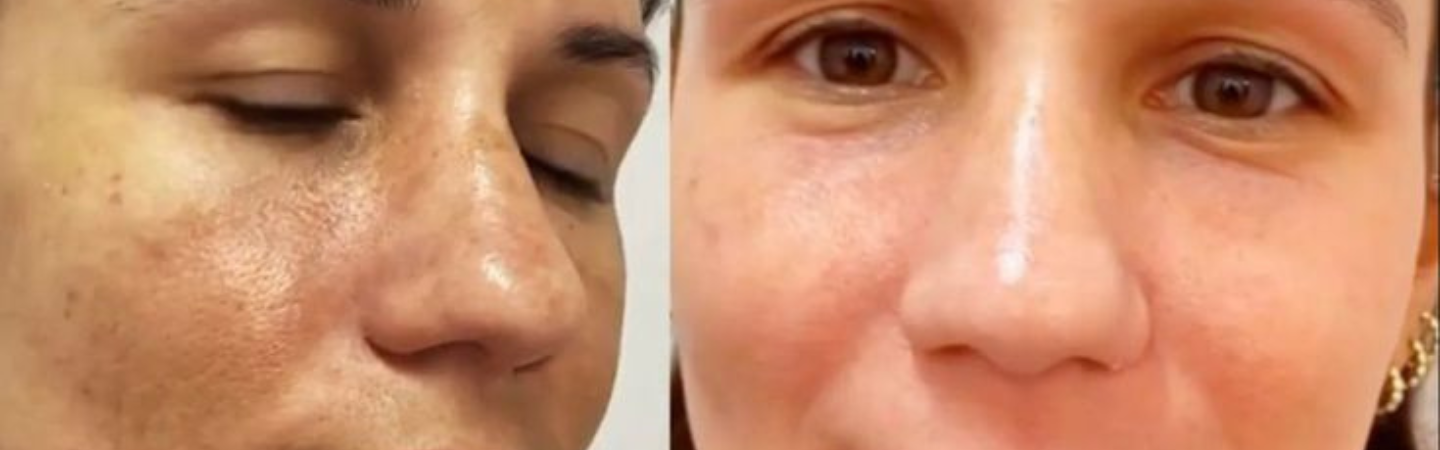 Melasma